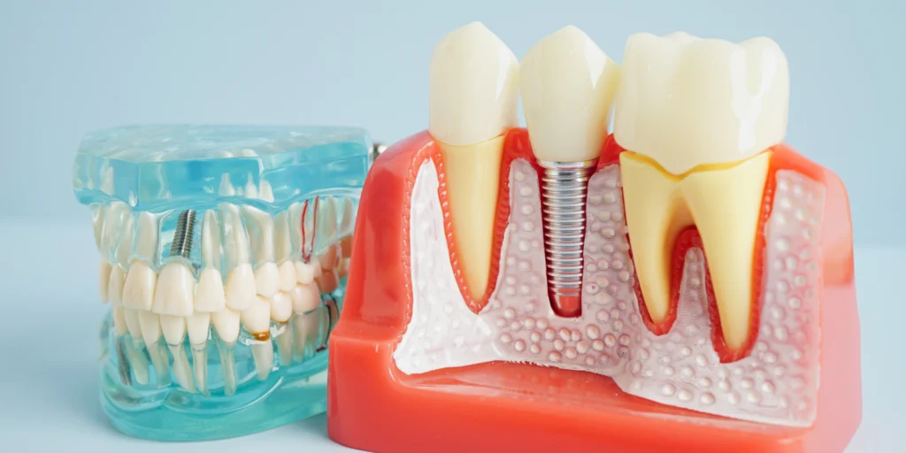 implant dentaire Implants dentaires Mediweb - Template 5