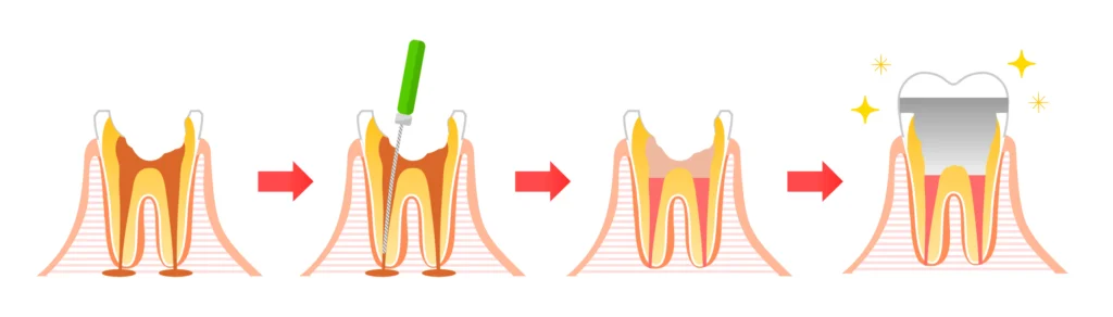 Consultation chez l’endodontiste