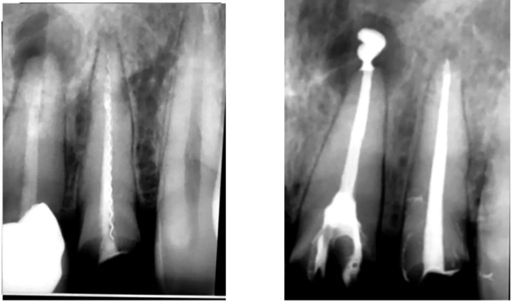 Dent dévitalisée en endodontie
