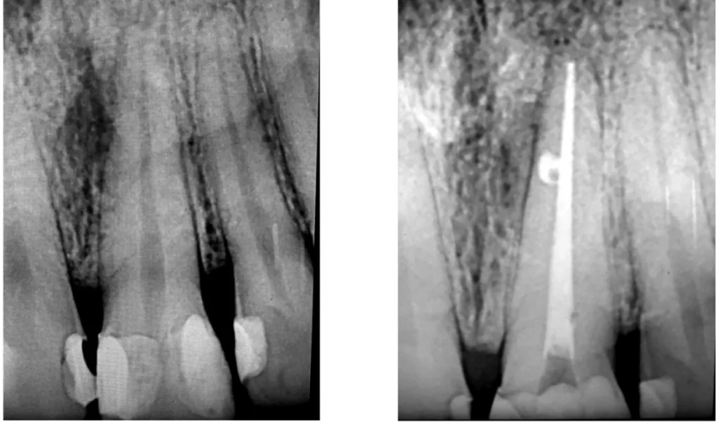 Dent douloureuse traitée par endodontie