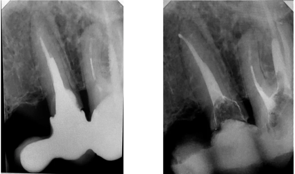 Endodontie : racines dentaires à Saint-Cyr-sur-Mer