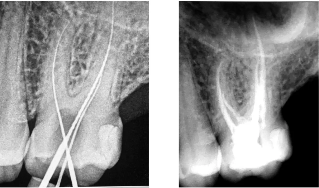Retraitement endodontique