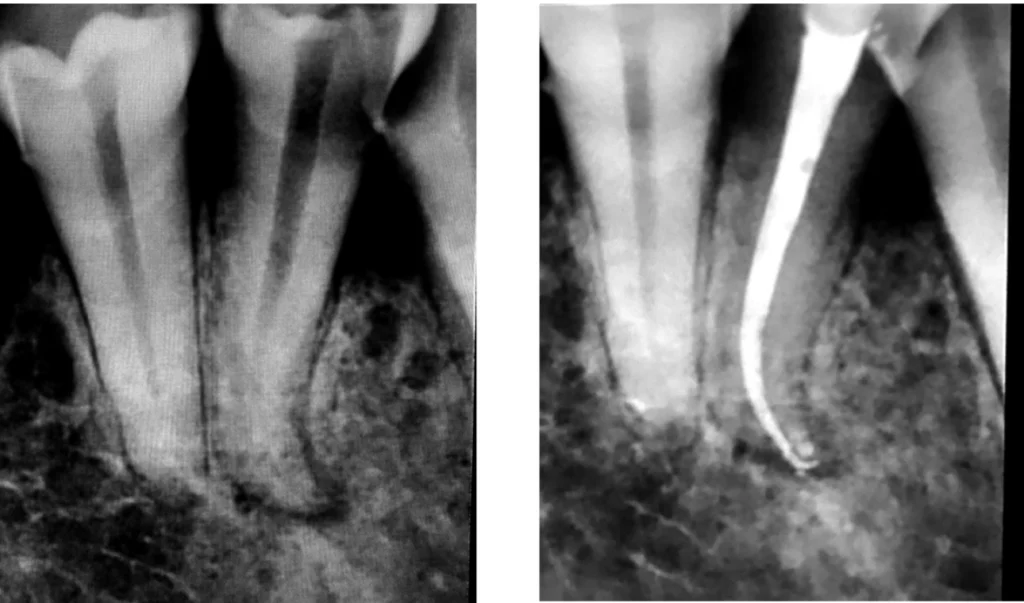 Retraitement endodontique à Saint-Cyr-sur-Mer